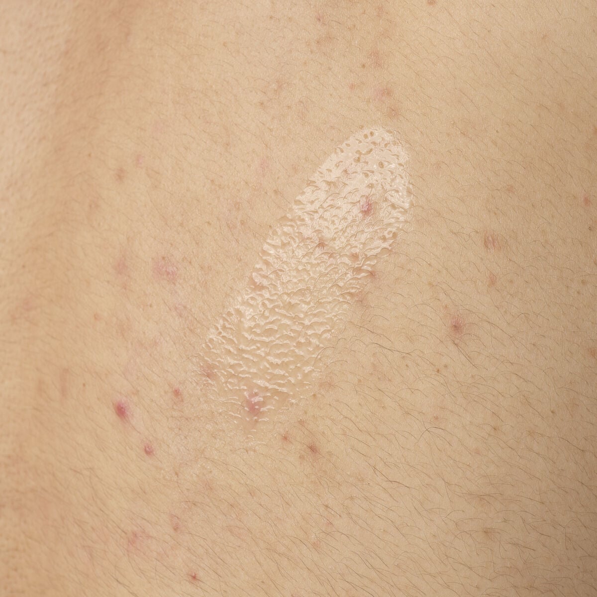 salicylic-acid-0-5-body-serum-z5 ORD-salicylic-acid-05-body-240ml-application.jpg
