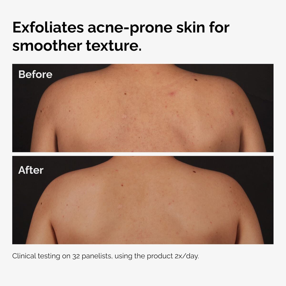 salicylic-acid-0-5-body-serum-z5 ord-salicylic-acid-body-serum-before-after-graphic-NA.jpg
