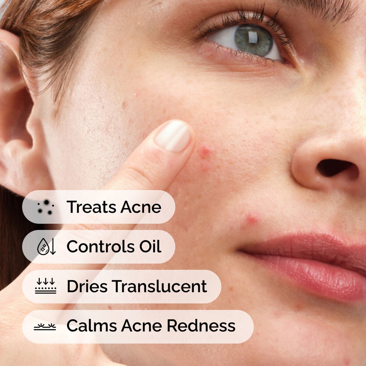 sulfur-10-powder-to-cream-concentrate-e6 ord-sulfur-10pct-powder-to-cream-concentrate-model-application-with-benefits-acne.jpg
