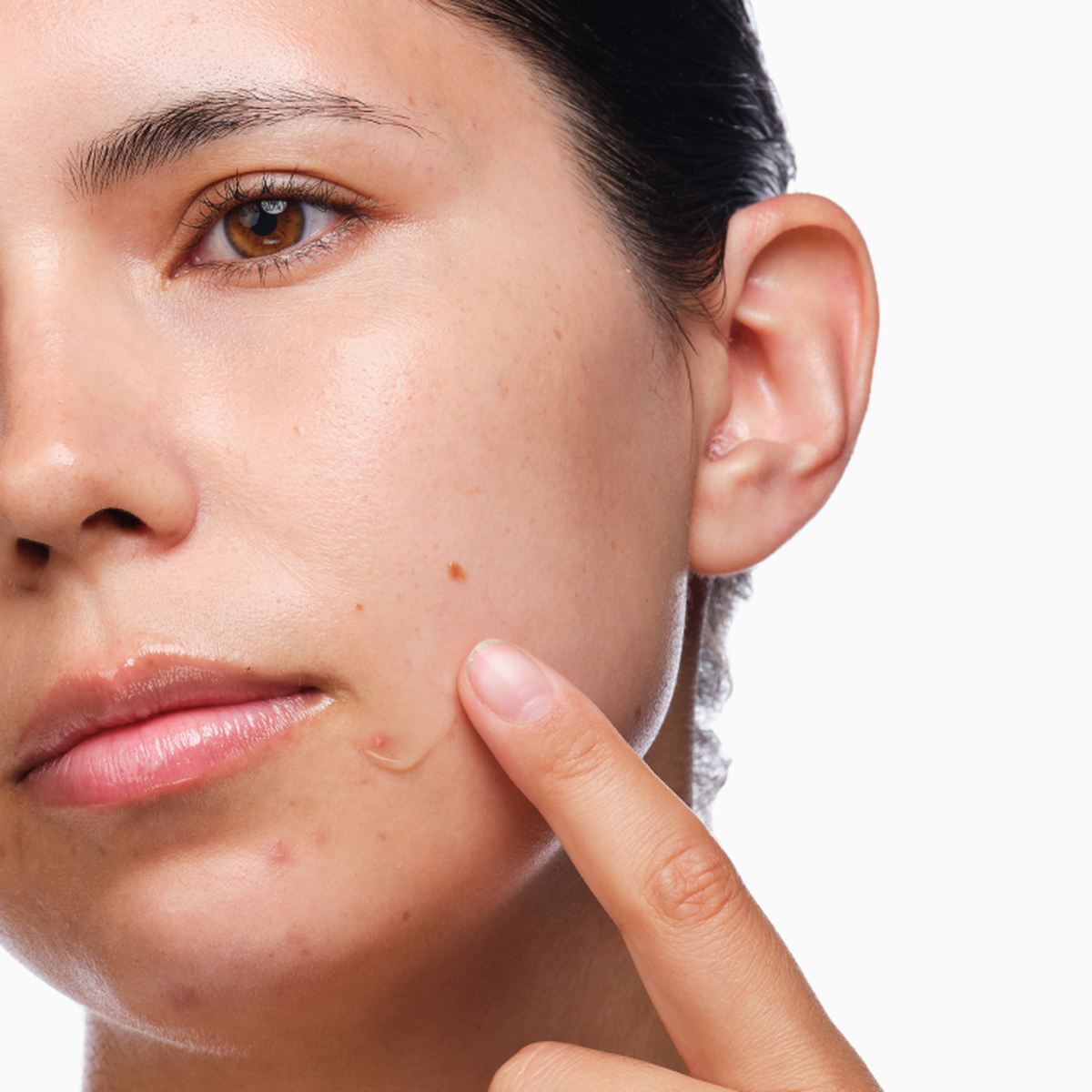 the-acne-set-w6 rdn-the-acne-set-application.png